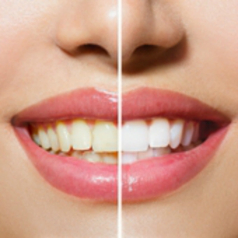WHITENING